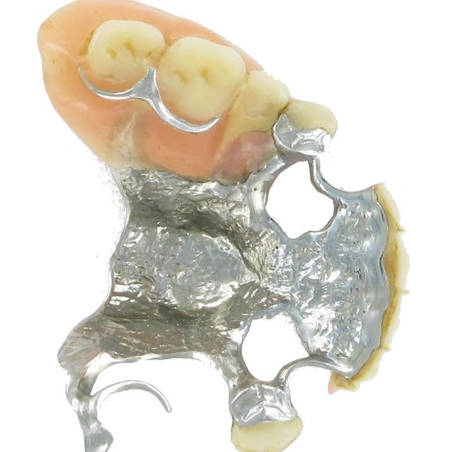Zahnspange ohne Edelmetall aus Mo/Cr/Co
