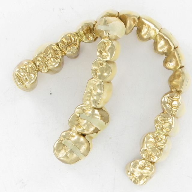 Goldimplantate als Zahnersatz